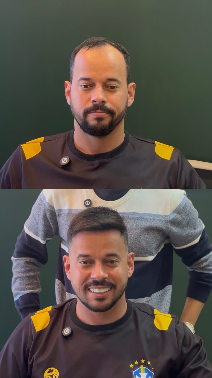 Antes e depois de prótese capilar: entradas e coroa preenchidas com a linha frontal refeita