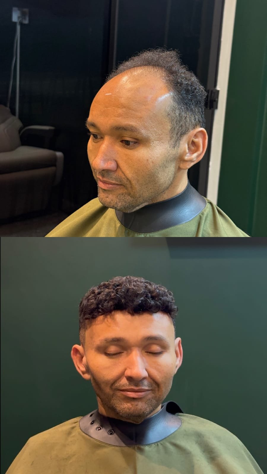 Antes e depois de prótese capilar com cachos refeitos no topo da cabeça