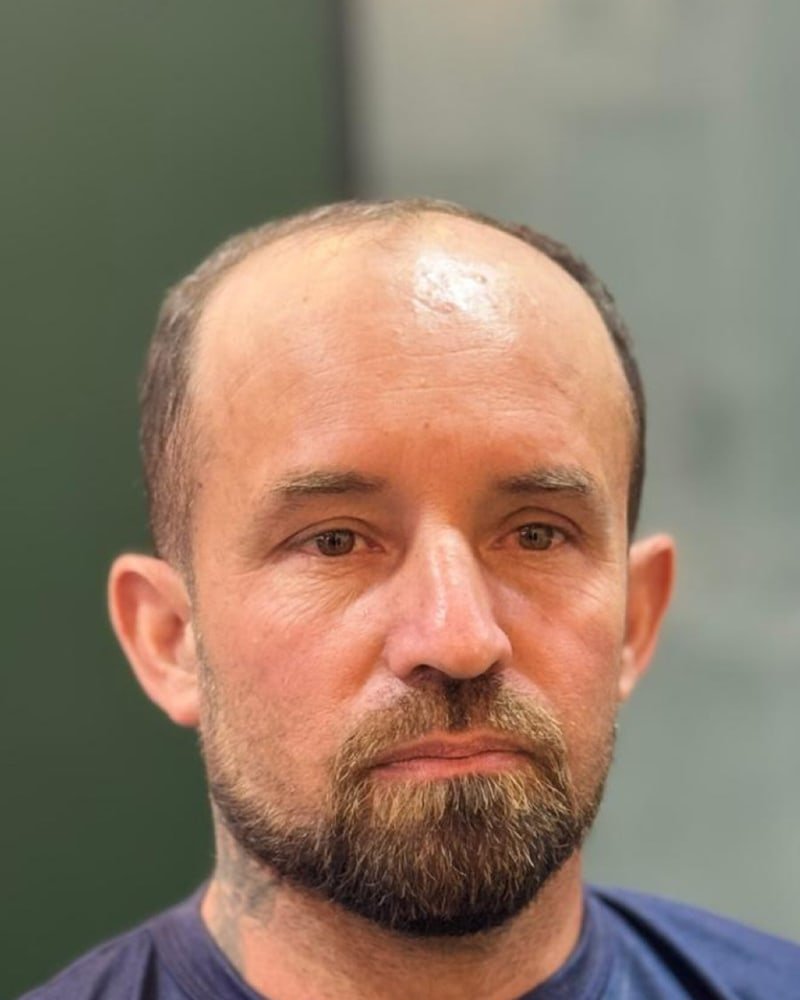 O mesmo cliente antes da prótese capilar, com o topo da cabeça calvo